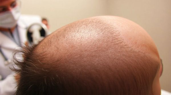 Top 5 avantages de la greffe de cheveux FUE à Nice